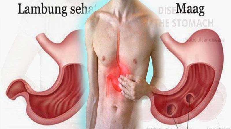 GERD Symptoms Called Chronic Gastric Acid, What Should Be Avoided?