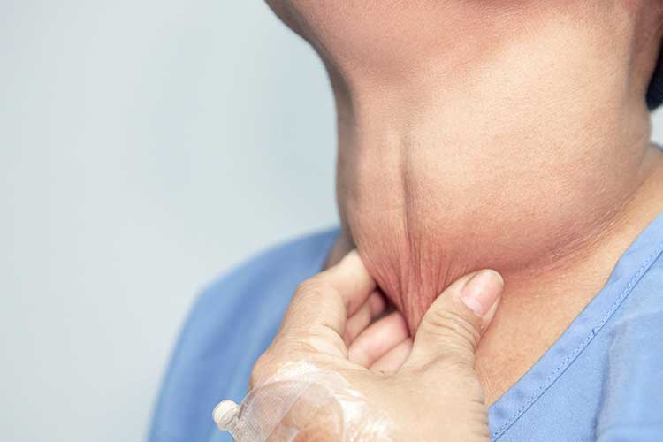 How to Prevent Goiter?