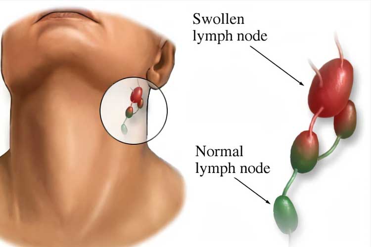 Lifestyle to Prevent Swollen Lymph Nodes