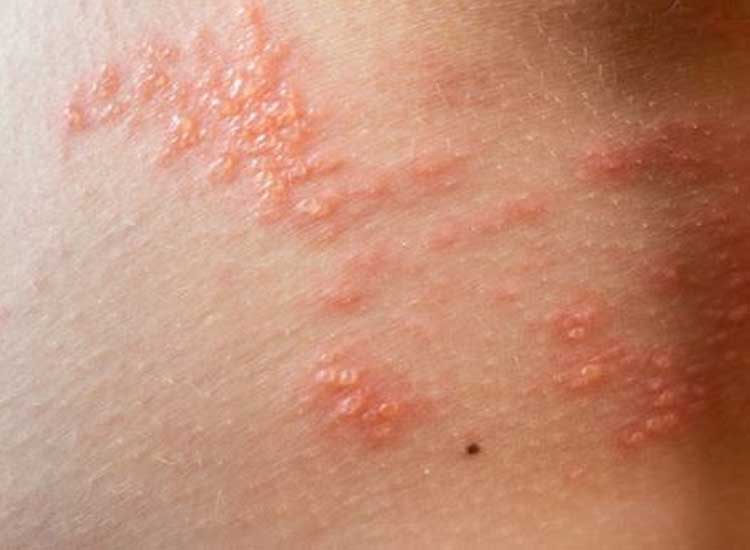 Mother, come on, find out 6 symptoms and ways to prevent chicken pox