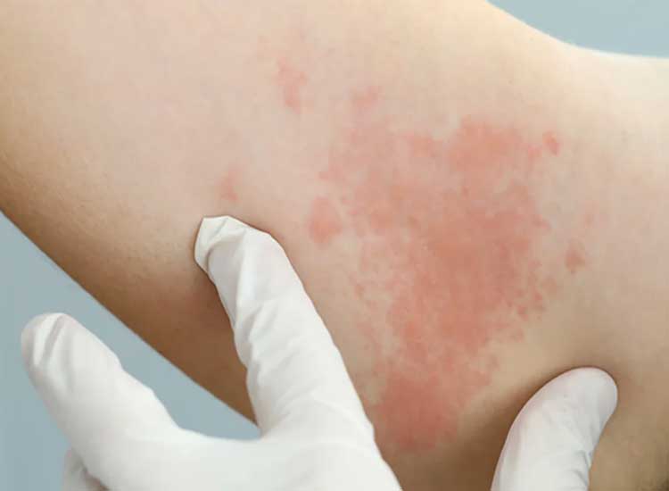 Get to know 7 types of skin diseases and how to treat them