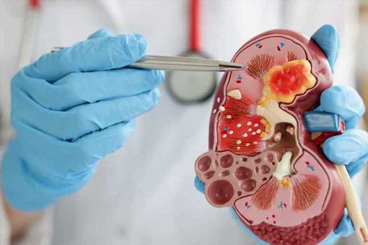 How to Treat Early Stage Kidney Disease Before It's Too Late