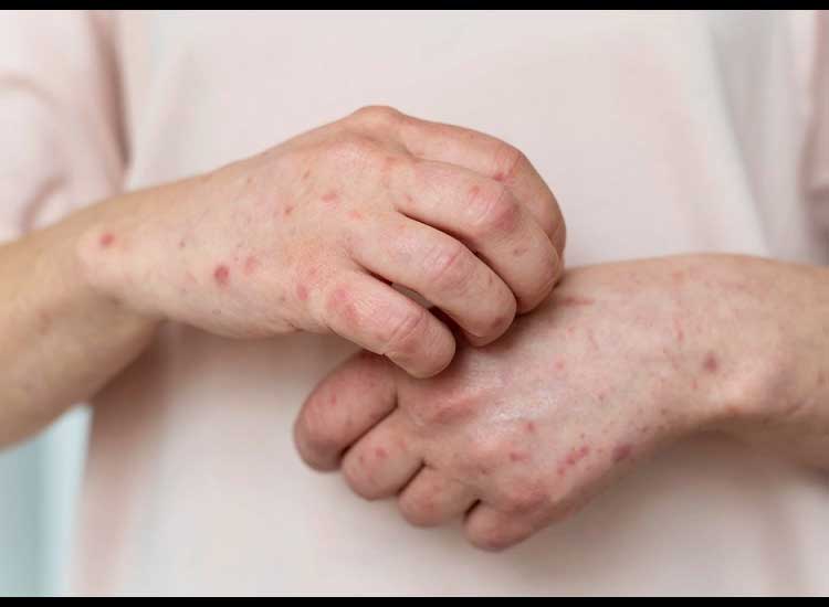 Note, this is how to treat chicken pox so that it dries quickly and disappears