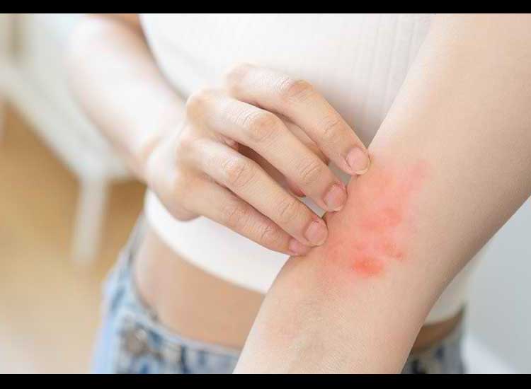 5 Ways to Treat Itchy Red Spots Naturally