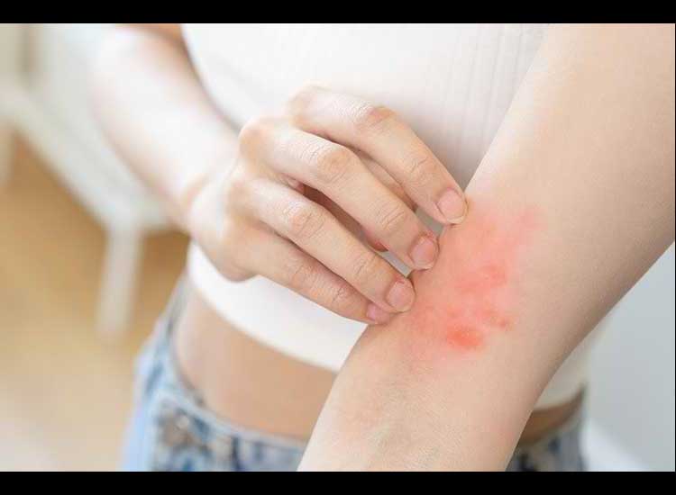 5 Ways to Treat Itchy Red Spots Naturally