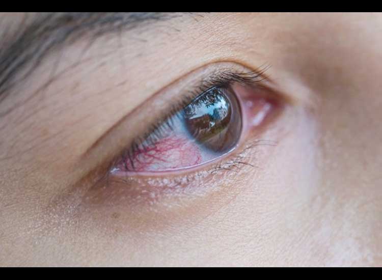 Red Eye on One Side, Know the Causes and Prevention