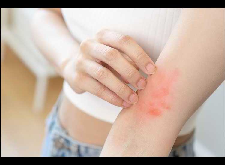 5 Ways to Treat Itchy Red Spots Naturally